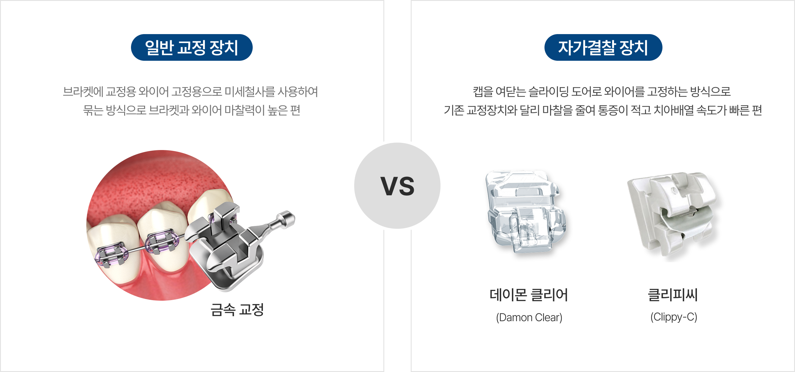 일반교정장치와 자가결찰장치의 차이